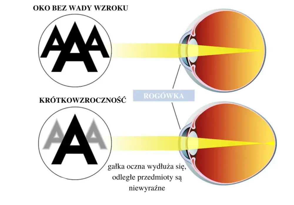 Ostrość wzroku 1.0 - co oznacza i czy to idealny wzrok?