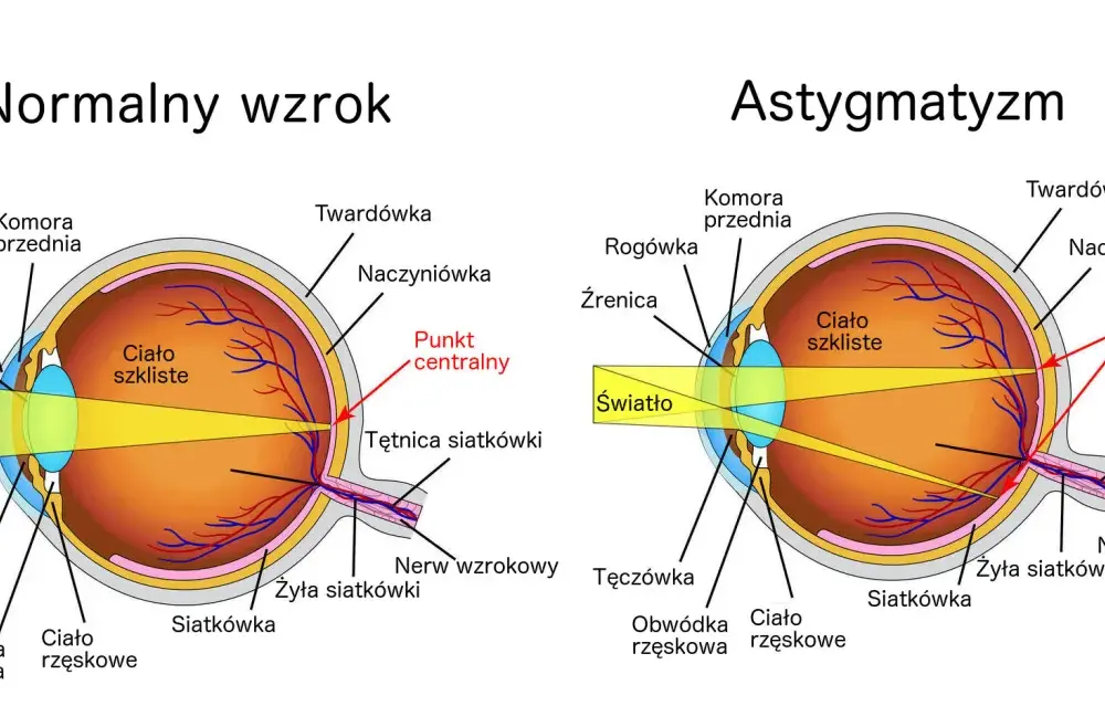 Astygmatyzm się powiększa? Jak kontrolować progresję wady