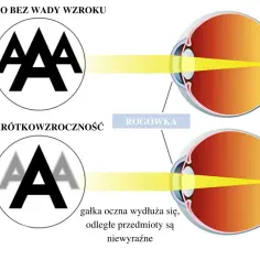 Oko z idealną ostrością wzroku 1.0 widzi wyraźnie. Krótkowzroczność powoduje, że odległe przedmioty są niewyraźne.