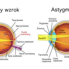 Porównanie budowy oka z astygmatyzmem i bez. Pokazuje, jak światło skupia się inaczej, co może sugerować, czy astygmatyzm się powiększa.