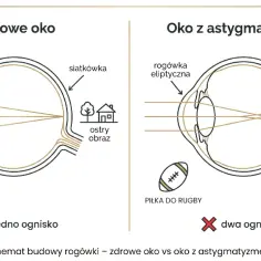 Zdrowe oko skupia światło na siatkówce, dając ostry obraz. Oko z astygmatyzmem, z eliptyczną rogówką, tworzy dwa ogniska, co powoduje rozmyty obraz.