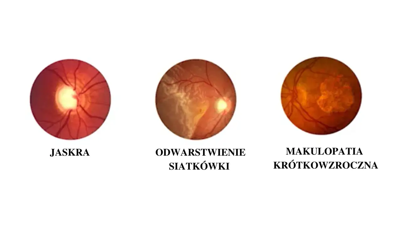 Obraz przedstawia trzy widoki dna oka: jaskrę, odwarstwienie siatkówki i makulopatię krótkowzroczną. Tak widzi osoba z wadą wzroku 10.