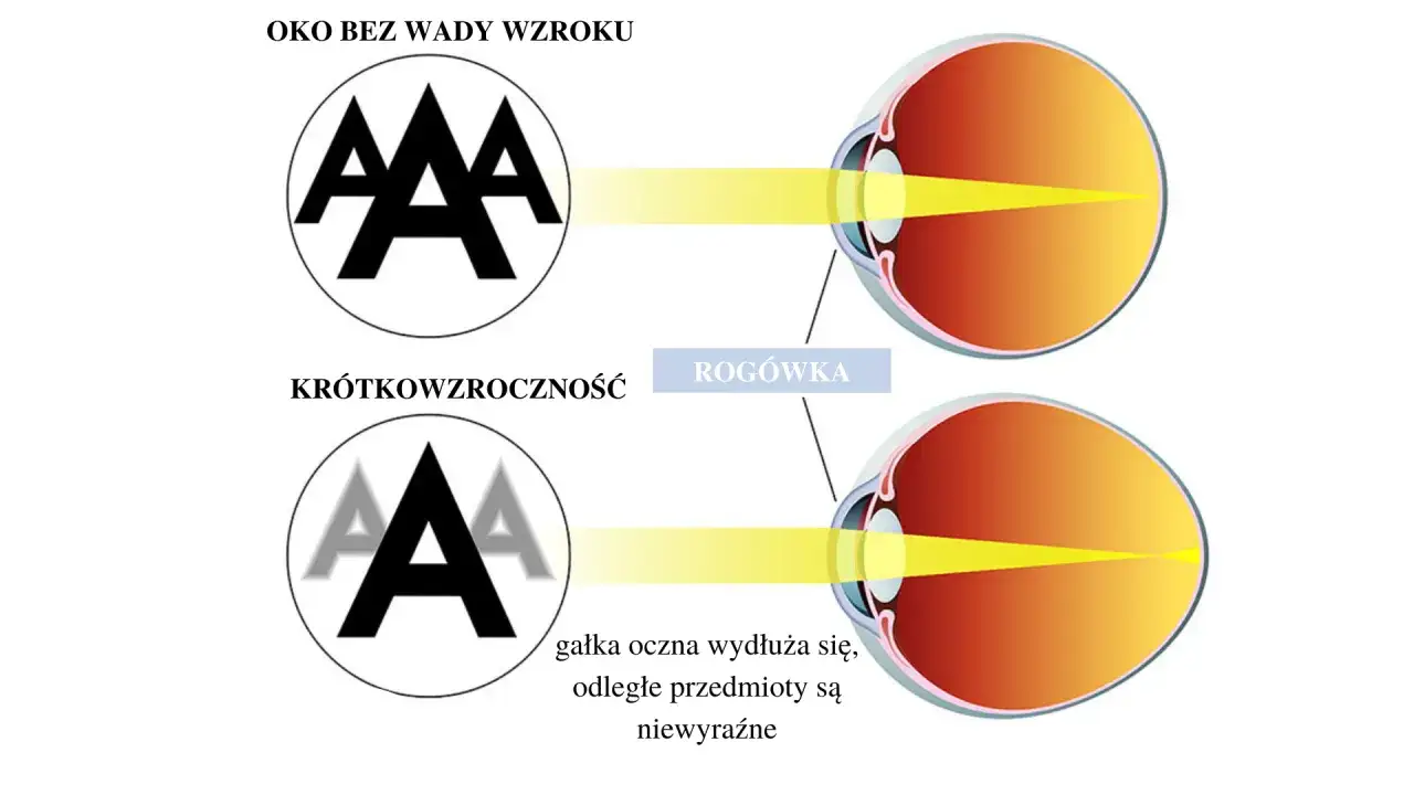 Oko z wadą wzroku (krótkowzroczność) widzi litery