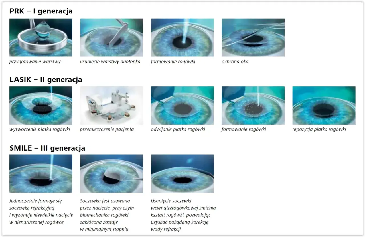 Ilustracja porównuje metody korekcji wzroku: PRK, LASIK, SMILE. Pokazuje etapy zabiegów, od przygotowania po formowanie rogówki, z uwzględnieniem potencjalnych powikłań po laserowej korekcji wzroku.