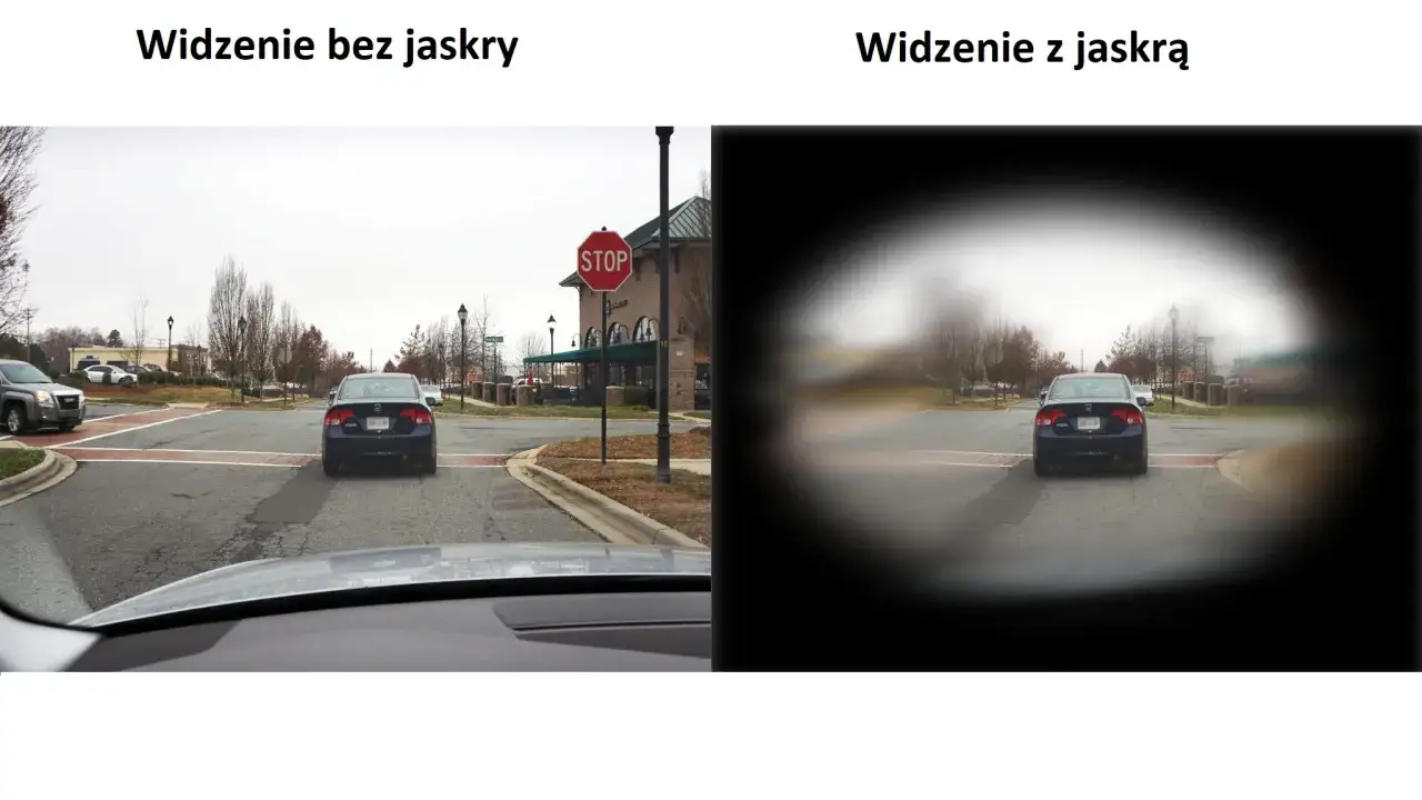 Porównanie widzenia: po lewej wyraźne, po prawej z jaskrą widzenie w nocy jest rozmyte, z ciemnymi obrzeżami.