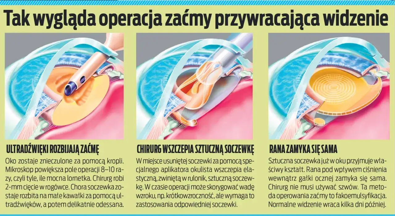 Ilustracje pokazują operację zaćmy: rozbijanie chorej soczewki ultradźwiękami, wszczepianie sztucznej soczewki i zamykanie rany. Kiedy operować drugie oko? Po kilku dniach.