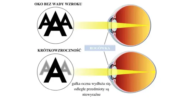 Soczewki na noc korygujące wzrok - Ostre widzenie w dzień?