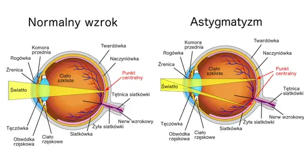 Astygmatyzm się powiększa? Jak kontrolować progresję wady